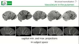 Combining vessel distance mapping and matrix to identify arterial and venous patterns in the putamen [upl. by Meryl388]