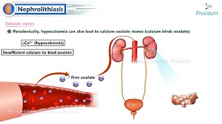 Nephrolithiasis  Kidney stones 🪨   Internal Medicine [upl. by Eenerb952]