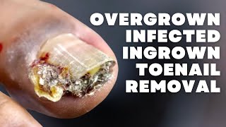 OVERGROWN INFECTED INGROWN TOENAIL REMOVAL WITH A SUPER SURPRISE [upl. by Boyce]