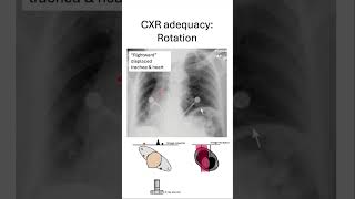 Chest xray adequacy ROTATION [upl. by Ahsinek]