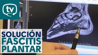 La solución para tratar la fascitis plantar [upl. by Aeht627]