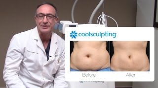 CoolSculpting Procedure Before and After with Dr Lista  The Plastic Surgery Clinic [upl. by Aerdnek947]