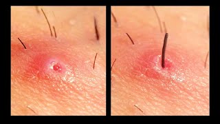 Ingrown hair removal [upl. by Prinz127]