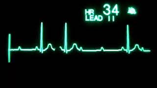 Bloqueo Auriculoventricular de 2° Mobitz II [upl. by Glendon28]