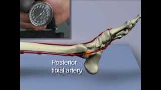 AnkleBrachial Index for Assessment of Peripheral Arterial Disease [upl. by Giacopo]