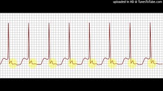 taquicardia paroxistica supraventricular ECOE podcast [upl. by Remle]