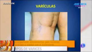 Tratamiento de Varices  Clínica Dermaline Madrid [upl. by Anaerol147]