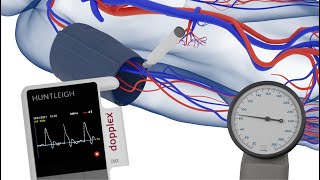 How to Measure the Brachial Pressures when Performing an ABPI [upl. by Llerrehs]