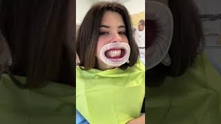 Metto le mascherine trasparenti ai denti shorts vlog dentist [upl. by Pancho794]