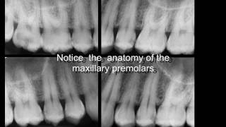 Three rooted maxillary premolars [upl. by Rugen]