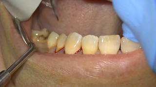 Scaling  Root Surface Debridement with Airpolishing [upl. by Schroer]