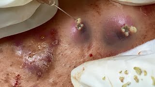 Big Cystic Acne Blackheads Extraction Blackheads amp Milia Whiteheads Removal Pimple Popping [upl. by Capone]