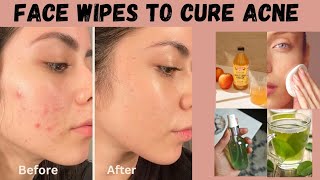 how to get rid of acne DIY face wipe pimples removal toner [upl. by Ahsiekam126]