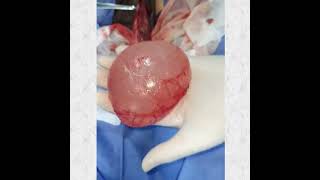 Large Spermatocele Excision استئصال كيس منوي كبير [upl. by Mert]