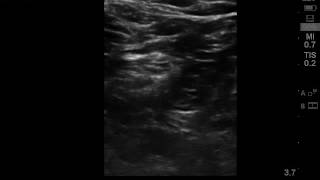 Ultrasound guided popliteal sciatic nerve block [upl. by Bower]