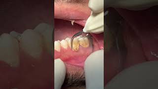 Cleaning teeth 🦷 dental scaling satisfying [upl. by Arracot]