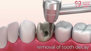 Removal of Tooth Decay [upl. by Ahsied]