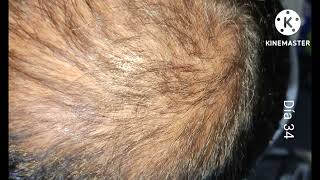 Mes y medio de tratamiento aplicando MINOXIDIL KIRLAND AL 5 para el cabello [upl. by Annovad897]