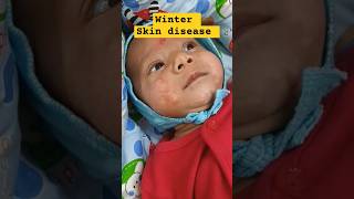 Dermatitis skin disease youtubeshorts shorts hospital cutebaby cute healthbabycare baby yt [upl. by Dennet753]