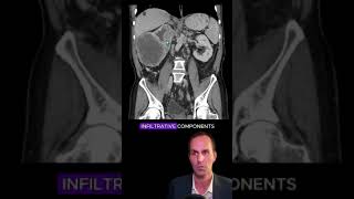 Renal cell carcinoma CT interpretation radiology medicalstudent radiologist radiographer [upl. by Atsed]