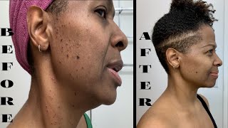 Facial Tiny Mole Removal Dermatosis Papulosa Nigra [upl. by Akehs]