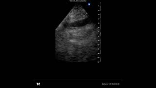 POCUS tamponade case [upl. by Lectra]