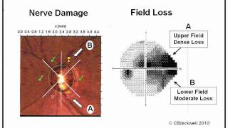 Glaucoma 1 Diagnosis [upl. by Dnaloy476]