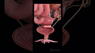 Cystitis  Dr Farrukh Iqbal  youtubeshorts shorts shortsfeed pakistan india ytshorts [upl. by Maidie]