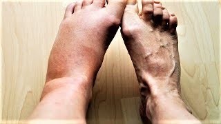 5 Home Remedies for Swollen Feet and Ankles  By Top 5 [upl. by Ennirac786]