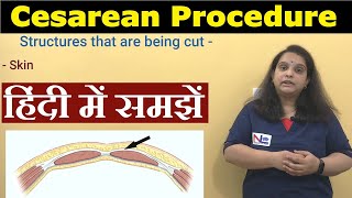 Cesarean Delivery in Hindi  Preoperative Care Procedure Postoperative care  Nursing Lecture [upl. by Nicoline]