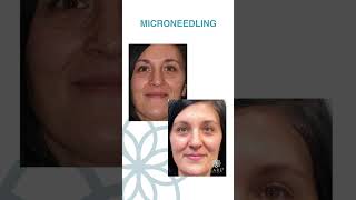 Microneedling with PRF  CARE Esthetics Before and After [upl. by Elayor]