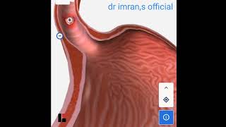 Esophegial squamus cell carcinoma [upl. by Anyahs]