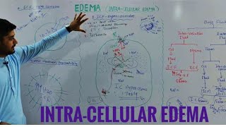 Intracellular edema pathophysiologyedema part 2 [upl. by Trillbee]