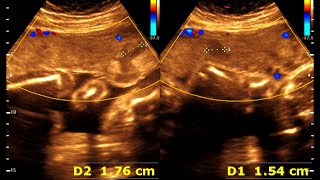 25 weeks 0 days pregnancy  Normal pregnancy  Placental lake [upl. by Hachmin]