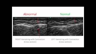 Hamstrings Injury Diagnosis [upl. by Ham]