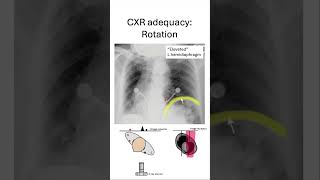 Chest xray adequacy ROTATION [upl. by Sirronal]