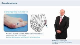 Diagnostic de lHallux valgus [upl. by Ragas]