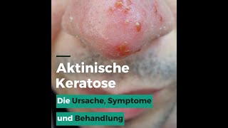 Aktinische Keratose [upl. by Leor73]