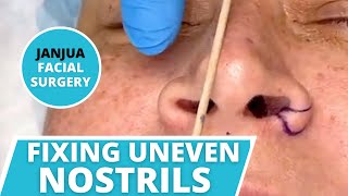 HOW TO FIX UNEVEN NOSTRILS ALARPLASTY NOSTRIL NARROWING  DR TANVEER JANJUA  NEW JERSEY [upl. by Lonier875]