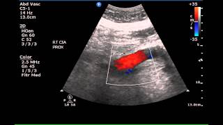 Sonographic Demonstration of Ectasia of the Iliac Arteries  Case Study [upl. by Ayek]