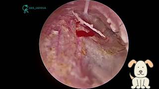 Tympanic membrane ruptureПерфорация барабанной перепонки [upl. by Feingold]