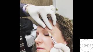 Botox for Brow Lift [upl. by Loferski]