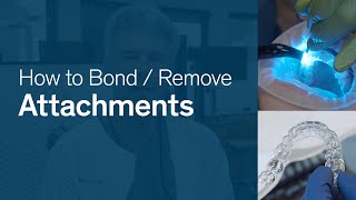 How To Bond amp Remove Attachments for Reveal® Clear Aligners [upl. by Tabby968]