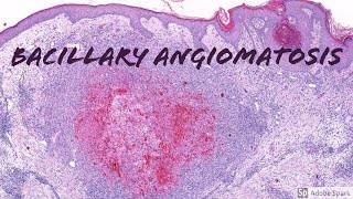 Bacillary Angiomatosis Dermatopathology Pearls [upl. by Assena400]