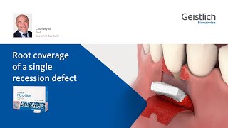 Root coverage of a single recession defect [upl. by Zerk]