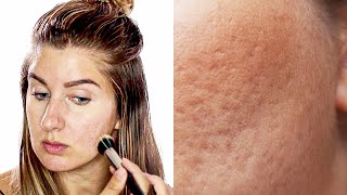 Dos And Donts To Applying Makeup On Pitted Acne Scars  Icepick Scars Boxcar scars [upl. by Adnohs330]