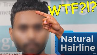 Worst Hair Transplant  Whats Unnatural Hairline [upl. by Elleral]