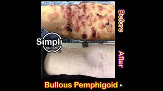 Bullous Pemphigoid Before and After [upl. by Ybbil110]