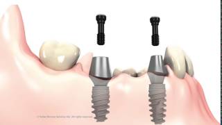 3 unit Bridge on implant abutments [upl. by Kelci]