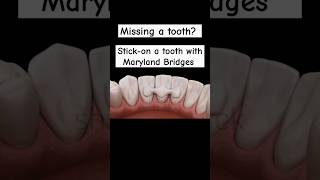 HOW TO TO FILL YOUR MISSING TOOTH  MARYLAND BRIDGES shorts usaukdentist [upl. by Billie]